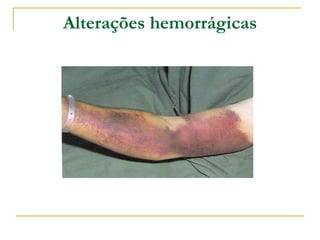 Alterações hemorrágicas
 