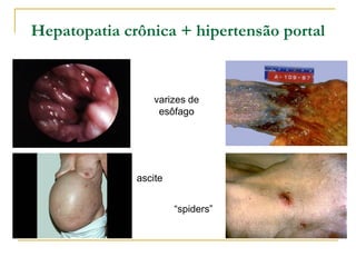 Hepatopatia crônica + hipertensão portal


                  varizes de
                   esôfago




              ascite


                       “spiders”
 