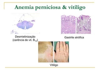 Anemia perniciosa & vitiligo



  Desmielinização                   Gastrite atrófica
(carência de vit. B12)




                         Vitiligo
 