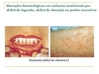 Alterações hematológicas em carências nutricionais por
deficit de ingestão, deficit de absorção ou perdas excessivas




               Escorbuto (deficit de vitamina C)
 
