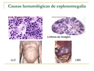 Causas hematológicas de esplenomegalia




                   Linfoma de Hodgkin




 LLC                                    LMC
 