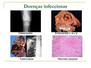 Doenças infecciosas




Osteomielite     Endocardite v. a-v d




Tuberculose        Necrose caseosa
 