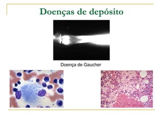 Doenças de depósito




    Doença de Gaucher
 