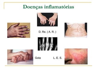 Doenças inflamatórias



      D. Re. ( A. R. )




    Gota           L. E. S.
 