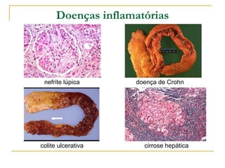 Doenças inflamatórias




 nefrite lúpica     doença de Crohn




colite ulcerativa     cirrose hepática
 