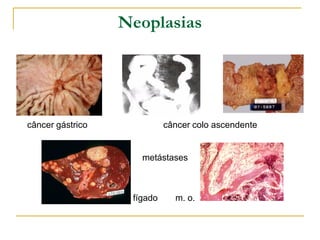 Neoplasias




câncer gástrico             câncer colo ascendente


                     metástases



                   fígado     m. o.
 