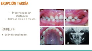 ERUPCIÓN TARDÍA
- Presencia de un
obstáculo
- Retraso de 6 a 8 meses
Tratamiento:
● Es individualizado.
 