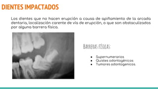 DIENTES IMPACTADOS
Los dientes que no hacen erupción a causa de apiñamiento de la arcada
dentaria, localización carente de vía de erupción, o que son obstaculizados
por alguna barrera física.
Barreras físicas:
● Supernumerarios
● Quistes odontogénicos
● Tumores odontogenicos.
 