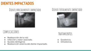 DIENTES IMPACTADOS
Diente totalmente impactado
Diente parcialmente impactado
COMPLICACIONES
TRATAMIENTOS
● Reabsorción de la raíz
● Infección y dolor asociado.
● Quistes dentígeros
● Reabsorción externa del diente impactado.
● Exodoncia.
● Ortodoncia.
 
