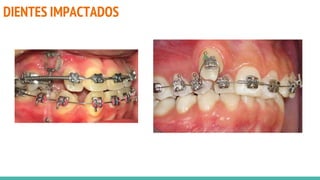 DIENTES IMPACTADOS
 
