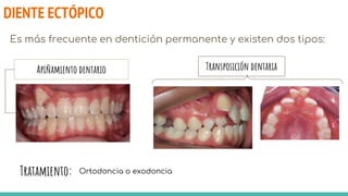 DIENTE ECTÓPICO
Es más frecuente en dentición permanente y existen dos tipos:
Tratamiento: Ortodoncia o exodoncia
Apiñamiento dentario Transposición dentaria
 