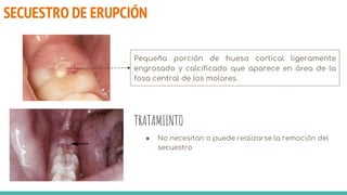 SECUESTRO DE ERUPCIÓN
Pequeña porción de hueso cortical ligeramente
engrosado y calcificado que aparece en área de la
fosa central de los molares.
● No necesitan o puede realizarse la remoción del
secuestro
TRATAMIENTO
 