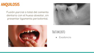 ANQUILOSIS
Fusión parcial o total del cemento
dentario con el hueso alveolar, sin
presentar ligamento periodontal.
TRATAMIENTO:
● Exodoncia
 