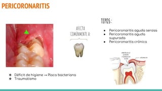 PERICORONARITIS
TIPOS:
● Pericoronaritis aguda serosa
● Pericoronaritis aguda
supurada
● Pericoronaritis crónica
AFECTA
COMÚNMENTE A:
❖ Déficit de higiene → Placa bacteriana
❖ Traumatismo
 