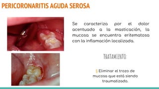 PERICORONARITIS AGUDA SEROSA
TRATAMIENTO:
§ Eliminar el trozo de
mucosa que está siendo
traumatizado.
Se caracteriza por el dolor
acentuado a la masticación, la
mucosa se encuentra eritematosa
con la inflamación localizada.
 
