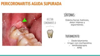 PERICORONARITIS AGUDA SUPURADA
AFECTAN
COMÚNMENTE A:
SÍNTOMAS:
Edema facial, halitosis,
dolor intenso y
espontáneo.
tratamiento:
- Desbridamiento
- Irrigar con clorhexidina
- Antibioterapia
- AINE
 