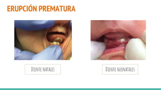 ERUPCIÓN PREMATURA
Diente neonatales
Diente natales
 