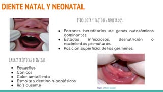 DIENTE NATAL Y NEONATAL
Etiología y Factores asociados:
● Patrones hereditarios de genes autosómicos
dominantes.
● Estados infecciosos, desnutrición o
nacimientos prematuros.
● Posición superficial de los gérmenes.
Características clínicas
● Pequeños
● Cónicos
● Color amarillento
● Esmalte y dentina hipoplásicos
● Raíz ausente
 
