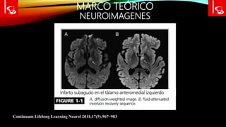 MARCO TEÓRICO
NEUROIMAGENES
Continuum Lifelong Learning Neurol 2011;17(5):967–983
Infarto subagudo en el tálamo anteromedial izquierdo
 