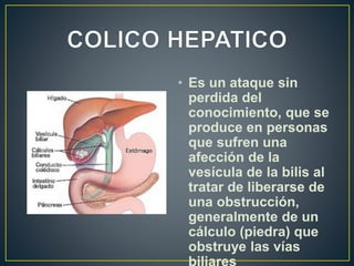 • Es un ataque sin
perdida del
conocimiento, que se
produce en personas
que sufren una
afección de la
vesícula de la bilis al
tratar de liberarse de
una obstrucción,
generalmente de un
cálculo (piedra) que
obstruye las vías
 