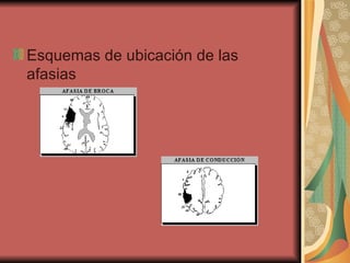 Esquemas de ubicación de las afasias  