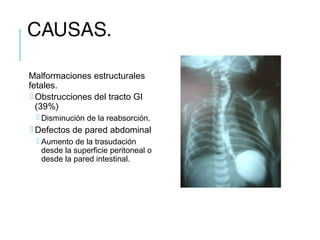 CAUSAS.
Malformaciones estructurales
fetales.
 Obstrucciones del tracto GI
(39%)
 Disminución de la reabsorción.
 Defectos de pared abdominal
 Aumento de la trasudación
desde la superficie peritoneal o
desde la pared intestinal.
 