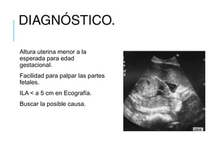 DIAGNÓSTICO.
Altura uterina menor a la
esperada para edad
gestacional.
Facilidad para palpar las partes
fetales.
ILA < a 5 cm en Ecografía.
Buscar la posible causa.
 