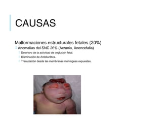 CAUSAS
Malformaciones estructurales fetales (20%)
 Anomalías del SNC 26% (Acrania, Anencefalia)
 Deterioro de la actividad de deglución fetal.
 Disminución de Antidiurética.
 Trasudación desde las membranas meníngeas expuestas.
 
