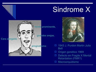Sindrome X 1943 J. Purdon Martin Julia Bell Origen genético 1969 Defecto en Fragile X Mental Retardation (FMR1) Macroorquidismo Cara alargada frente prominente, prognatismo grandes orejas.  