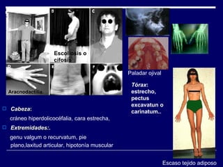 Cabeza : cráneo hiperdolicocéfalia, cara estrecha,  Extremidades: .   genu valgum o recurvatum, pie plano,laxitud articular, hipotonía muscular Aracnodactilia. Paladar ojival Escaso tejido adiposo Tórax : estrecho, pectus excavatun o carinatum.. Escoliosis o cifosis 