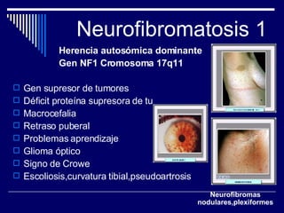 Neurofibromatosis 1 Herencia autosómica dominante Gen NF1 Cromosoma 17q11 Gen supresor de tumores Déficit proteína supresora de tu Macrocefalia Retraso puberal Problemas aprendizaje Glioma óptico Signo de Crowe Escoliosis,curvatura tibial,pseudoartrosis Neurofibromas nodulares,plexiformes 