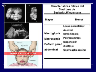 Características fetales del Sindrome de  Beckwith.Wiedemann Mayor  Menor Macroglosia Macrosomía Defecto pared  abdominal Locus aneuploide/ Anormal Nefromegalia Polihidramnios Disgenesia/ displasia Citomegalia adrenal 
