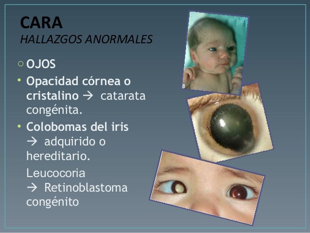 Hematoma Retrocorial Y Síndrome De Down