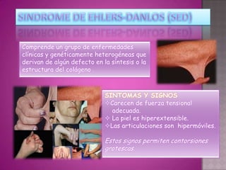 Comprende un grupo de enfermedades
clínicas y genéticamente heterogéneas que
derivan de algún defecto en la síntesis o la
estructura del colágeno .



                             SINTOMAS Y SIGNOS
                             Carecen de fuerza tensional
                               adecuada.
                              La piel es hiperextensible.
                             Las articulaciones son hipermóviles.

                             Estos signos permiten contorsiones
                             grotescas.
 
