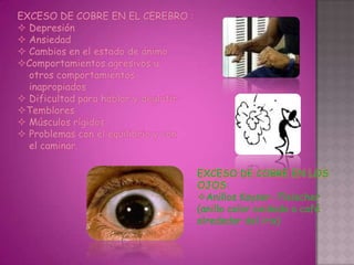 EXCESO DE COBRE EN EL CEREBRO :
 Depresión
 Ansiedad
 Cambios en el estado de ánimo
Comportamientos agresivos u
  otros comportamientos
  inapropiados
 Dificultad para hablar y deglutir
Temblores
 Músculos rígidos
 Problemas con el equilibrio y con
  el caminar.

                                      EXCESO DE COBRE EN LOS
                                      OJOS:
                                      Anillos Kayser- Fleischer
                                      (anillo color oxidado o café
                                      alrededor del iris)
 