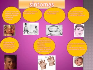 síntomas
   •Llanto de tono alto    •Bajo peso al nacer y          •Cabeza pequeña     •La facies suele ser
   similar al de un gato   crecimiento lento              (microcefalia)      redondeada y, con
   (a esto se debe el                                                         frecuencia, mofletuda
   nombre del
   síndrome)




                                              •Dedos de las manos
•Ojos separados                               y pies parcialmente
(hipertelorismo)                              unidos por                    •Orejas de implantación
•Inclinación de los                           membranas                     baja
ojos hacia abajo                              •Un solo pliegue en           •Excrecencia cutánea
                                              la palma de la mano           justo delante de la oreja
                                              (pliegue simiesco)
 