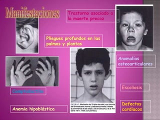 Trastorno asociado a
                          la muerte precoz



                 Pliegues profundos en las
                 palmas y plantas


                                                 Anomalías
                                                 osteoarticulares




                                                  Escoliosis
Camptodactilia

                                                  Defectos
Anemia hipoblástica                               cardiacos
 