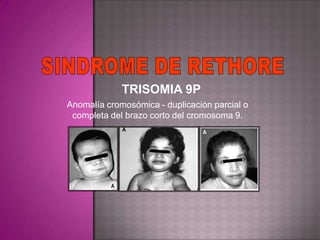 TRISOMIA 9P
Anomalía cromosómica - duplicación parcial o
 completa del brazo corto del cromosoma 9.
 