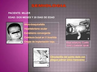 PACIENTE: MUJER
EDAD: DOS MESES Y 20 DIAS DE EDAD

           Micro-braquicefalia
           Hipertelorismo ocular
           Estrabismo convergente
           Comisura bucal en V invertida
           Orejas de implantación baja.           Baja estatura, Cuello
                                                  corto y paladar ojival.



                                   Clinodactilia del quinto dedo con
                                   pliegue palmar único transverso
 