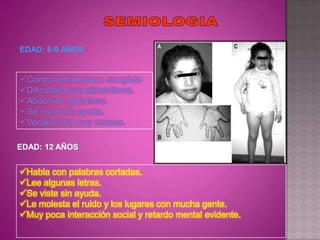 EDAD: 8-9 AÑOS.


Control esfinteriano completo
Dificultad para alimentarse.
Abdomen globuloso.
Se viste con ayuda.
Vocabulario muy escaso.

EDAD: 12 AÑOS


Habla con palabras cortadas.
Lee algunas letras.
Se viste sin ayuda.
Le molesta el ruido y los lugares con mucha gente.
Muy poca interacción social y retardo mental evidente.
 