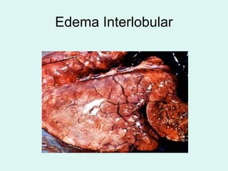 Edema Interlobular
 