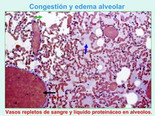 Congestión y edema alveolar




Vasos repletos de sangre y líquido proteináceo en alveolos.
 