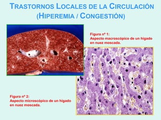 TRASTORNOS LOCALES DE LA CIRCULACIÓN
      (HIPEREMIA / CONGESTIÓN)

                                    Figura nº 1:
                                    Aspecto macroscópico de un hígado
                                    en nuez moscada.




Figura nº 2:
Aspecto microscópico de un hígado
en nuez moscada.
 