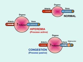 Órgano

                                  Arteria               Vena


          Órgano
                                                       NORMAL
Arteria               Vena
          Volumen

                     HIPEREMIA
                     (Proceso activo)
                                            Órgano


                                                             Obstrucción
                              Arteria                 Vena
                                            Volumen

                    CONGESTIÓN
                    (Proceso pasivo)
 