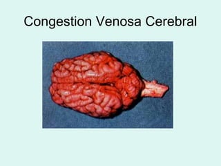 Congestion Venosa Cerebral
 