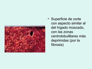 • Superficie de corte
  con aspecto similar al
  del hígado moscado,
  con las zonas
  centrolobulillares más
  deprimidas (por la
  fibrosis)
 