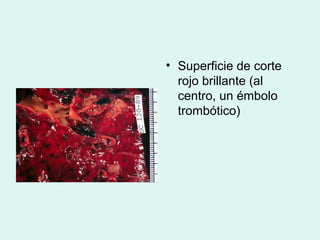 • Superficie de corte
  rojo brillante (al
  centro, un émbolo
  trombótico)
 
