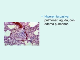 • Hiperemia pasiva
  pulmonar, aguda, con
  edema pulmonar.
 