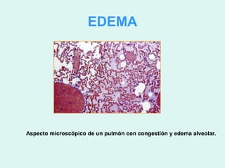 EDEMA




Aspecto microscópico de un pulmón con congestión y edema alveolar.
 