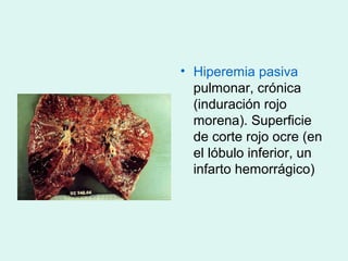 • Hiperemia pasiva
  pulmonar, crónica
  (induración rojo
  morena). Superficie
  de corte rojo ocre (en
  el lóbulo inferior, un
  infarto hemorrágico)
 